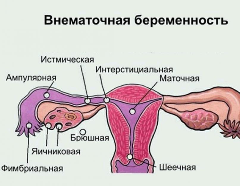 Вагітність після стерилізації: Чи можливо зачати, Перев'язка труб під час кесаревого розтину, Як завагітніти.  Стерилізація – «крайній захід» жіночої контрацепції Як завагітніти після стерилізації труб